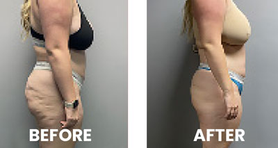 medwave-results Softwave Therapy Houma in action for shoulder pain